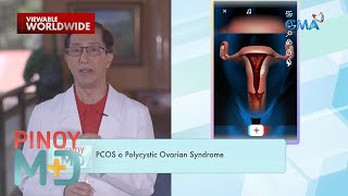 Ano ang dahilan sa pagkakaroon ng PCOS o Polycystic Ovarian Syndrome  Pinoy MD [upl. by Nixon]