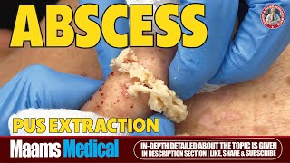 How to Extract an Inflamed Abscess From a Cyst  Abscess Drainage amp Cyst Removal Tutorial [upl. by Carolus59]