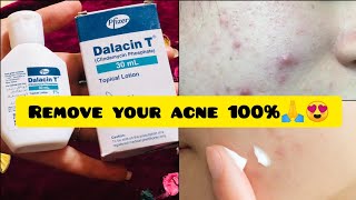 100 Remove Acne amp pimple🔥  Guaranteed results self tested ✨  Dalacin T lotion honest review❤️ [upl. by Dewitt]