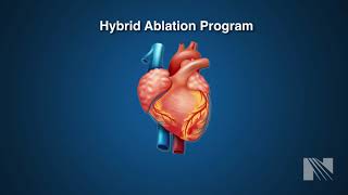 Atrial Fibrillation Treatment Hybrid Atrial Fibrillation AF Ablation [upl. by Tingey317]