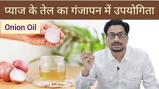 प्याज के तेल का गंजापन में उपयोगिता  Onion Oil for Hair Fall Alopecia onionoilforhairgrowth onion [upl. by Olds]