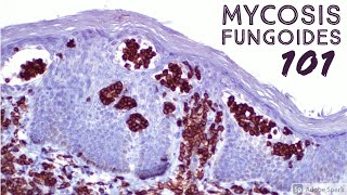 Mycosis Fungoides 101 Cutaneous Tcell Lymphoma CTCL for Dermatopathology Pathology Dermatology [upl. by Finah]