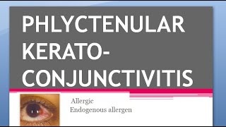 Ophthalmology PHLYCTENULAR KERATOCONJUNCTIVITIS KERATITIS TB Miliary Sacrofulous Fascicular Salzmann [upl. by Michelsen]