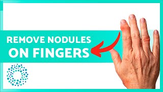 How to CURE NODULES on the FINGERS of the HANDS 🖐🏻 [upl. by Pastelki]