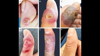 Ecthyma contagiosum durch Schafpockenvirus Orf [upl. by Mesics]