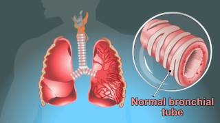 what are the Symptoms Of Tuberculosis [upl. by Lalo25]