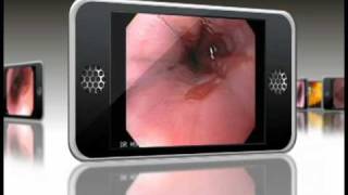 Barrett Esophagus Endoscopic Animation [upl. by Jenifer]