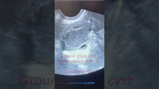 Endometriosis infertilityChochlate ovary cyst treatmenttrendingshorts viralsongendometriosisivf [upl. by Ardnod]