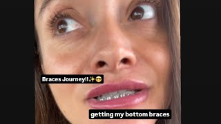 BRACES UPDATE Getting bottom braces Canine tooth coming in ‼️🦷🤓 braces bracesjourney braceface [upl. by Riane]