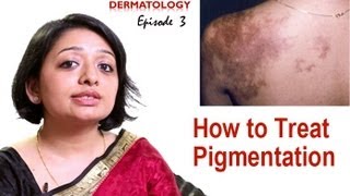 How to Treat Skin Pigmentation Episode 3 [upl. by Anialeh]