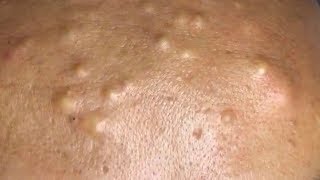 How To Remove Blackheads And Whiteheads On Face Easy 122 ✦ Dr Laelia ✦ [upl. by Henn]