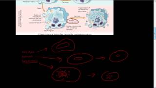 8  Micro and Macro morphology of necrosis  karyolysis pyknosis karyorrhexis necrosis [upl. by Klenk]