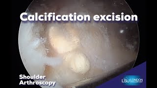 Shoulder arthroscopy calcification excision by Rupen Dattani London [upl. by Brina]