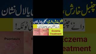 Chambal Ka llaj  Eczema Ka Ilaj  How To Treat Eczema  Eczema Treatment In UrduHindi ytshorts [upl. by Yelrac]