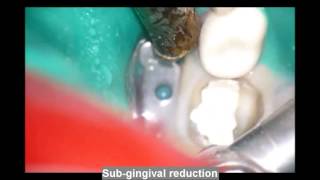 Treatment of primary molar with NuSmile ZR crown [upl. by Pul]