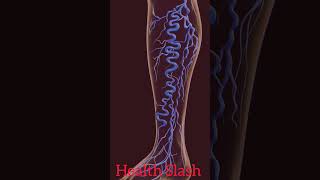 Varicose veins 3D Animation healthslash [upl. by Kelvin]