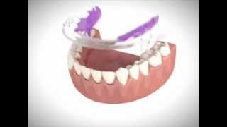 Inman Aligner Introduction Video [upl. by Seitz]