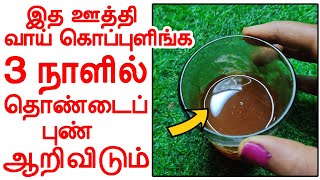 3 நாளில் தொண்டைப்புண் ஆற இத ஊத்தி கொப்புளிங்க  thondai punnu home remedies in tamil [upl. by Baxter]