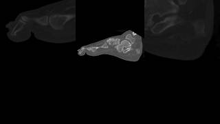 Chopart fracture dislocation ctfoot [upl. by Nawj]