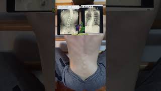 Scoliosis at Mobility MedClinic Toronto 🇨🇦 afrobeat love afrobeats scoliosiswarrior [upl. by Adeirf]