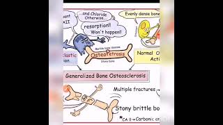 Osteopetrosis Bone Pathology [upl. by Beller]