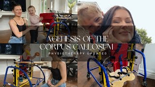 Agenesis of the Corpus Callosum  Physiotherapy Updates [upl. by Zurciram812]