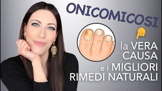 🦶🖐 Onicomicosi qual è la vera causa e quali sono i possibili rimedi naturali [upl. by Ezekiel]