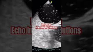 Patent Foramen Ovale echocardiography echocardiogram cardiology [upl. by Ynnod]