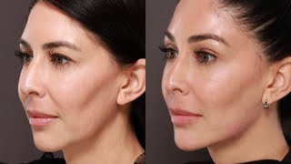 Exclusive look at Jawline Filler Definition and Contouring [upl. by Dibrin132]