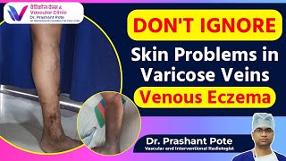 Dont Ignore These Symptoms Venous Eczema amp Varicose Veins Explained  Dr Prashant Pote [upl. by Nawed]