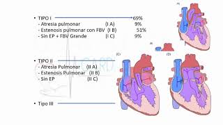 Atresia tricuspidea [upl. by Godwin]