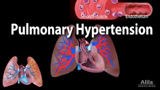 Pulmonary Hypertension Animation [upl. by Accebor]