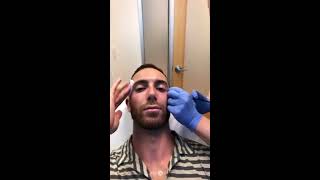 Chin Jaw and Temple Augmentation with Fillers  Male Facial Sculpting  Live [upl. by Eserehc492]