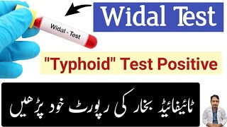 Widal Test Urdu Hindi  How To Read Typhoid Widal Test Report Widal Test Positive  Irfan Azeem [upl. by Ihsar]