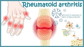 Rheumatoid Arthritis  autoimmune disorder  Pathophysiology risk factors treatment [upl. by Netsirt]