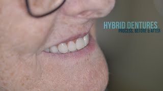 Hybrid DENTURES Process Before and After dentures smile dentistry painting teeth [upl. by Anirbus]