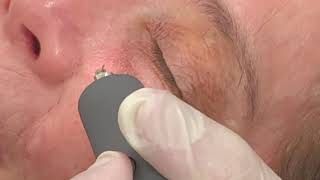 Subnovii Plasma Pen treatment at Sobel Skin in NYC [upl. by Ybbob]