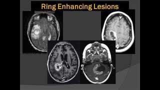 Brain Scans Lord of the Ring Enhancing Lesions 101 [upl. by Cormack631]