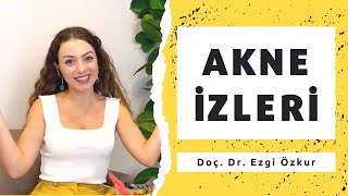 Sivilce İzleri Nasıl Geçer Akne İzleri Tedavisi  Doç Dr Ezgi Özkur [upl. by Adia]