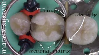 Class II Composite Restoration شرح عربي بسيط [upl. by Aracahs]