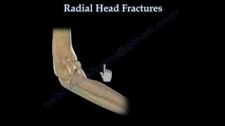 Radial Head Fracture Everything You Need To Know Dr Nabil Ebraheim [upl. by Katleen]