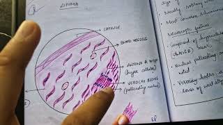 schwannoma histopathology gross and microscopic features [upl. by Ennaitsirk]