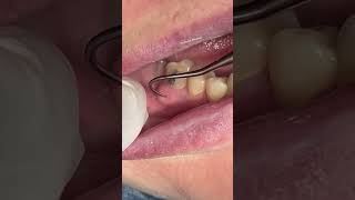 Dental abscess satisfying [upl. by Profant]