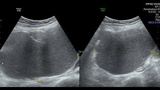 DERMOID OR ENDOMETRIOMA [upl. by Onibag]