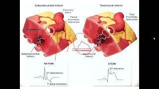 Arritmias Trastorno conducciónelectrolíticos HNGAI Angiocardiología  sem 8 [upl. by Salomi]