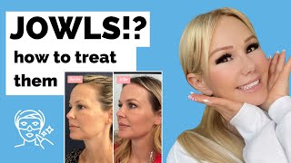 JOWLS How to treat them without surgery Thermafrax thread lifts fillers botox more [upl. by Perkin]