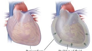 My Pericarditis or Heart Fluid Buildup I think it was caused by an infection It happened suddenly [upl. by Converse388]