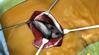 Pelvis Reduction and Fixation with Iliosacral screw [upl. by Inar335]