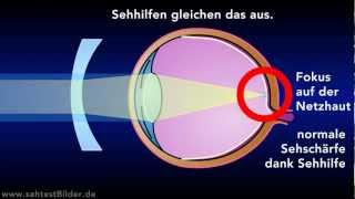 Was ist Kurzsichtigkeit kurzsichtig sehen [upl. by Craven846]