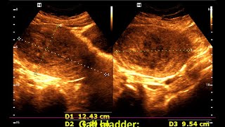 Understanding Large Intramural Fibroids Diagnosis and Management [upl. by Romney]